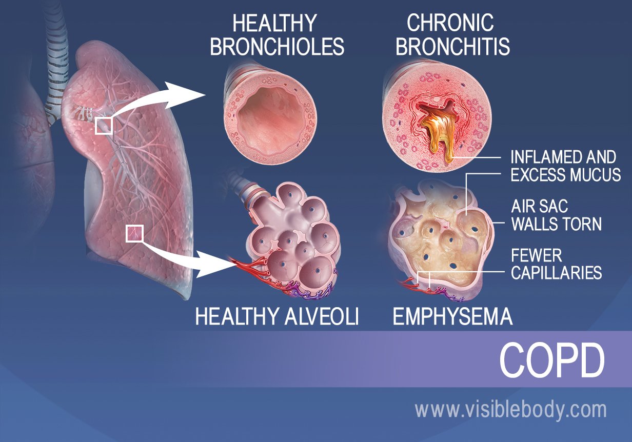 Bronchioles of those with chronic bronchitis are inflamed and have excess mucus. Alveoli of those with emphysema are torn, and have fewer capillaries