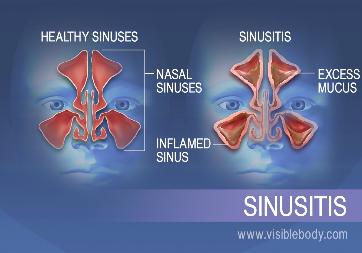 The sinuses of those with sinusitis have excess mucus and inflamed sinus walls