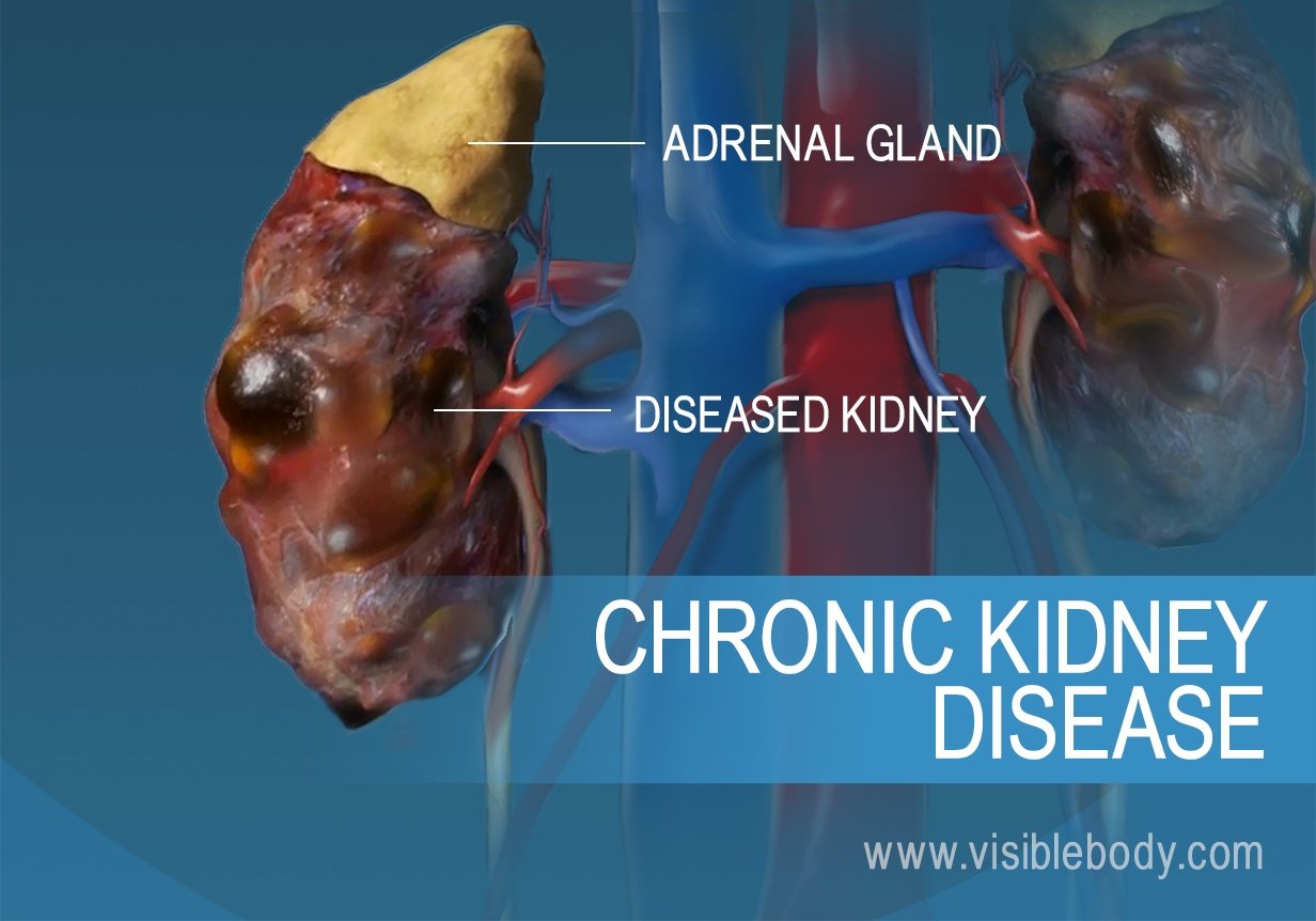 A comparison of healthy and diseased kidneys