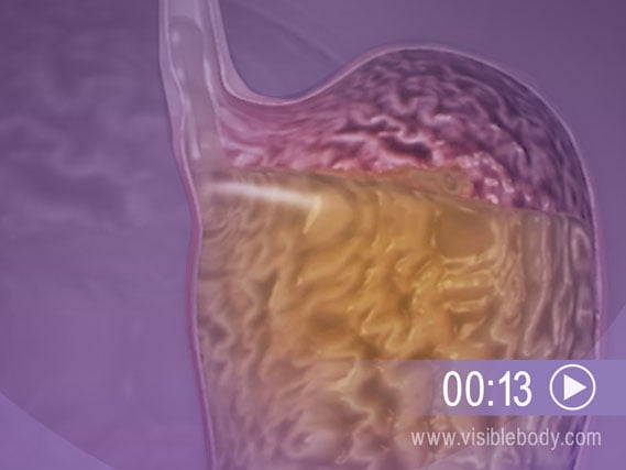 Cliquez ici pour visualiser une animation illustrant le reflux gastro-œsophagien