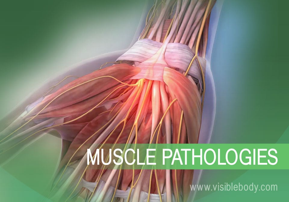 Muscle Pathologies