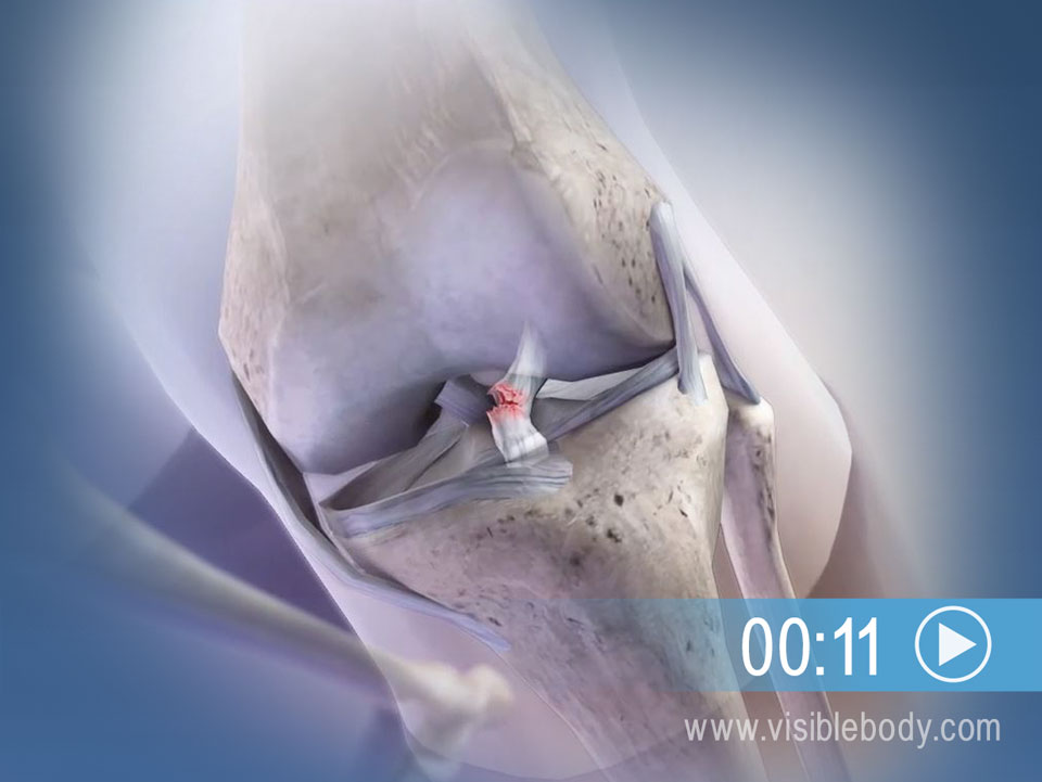 鋭い膝の動きが ACL の断裂につながる可能性