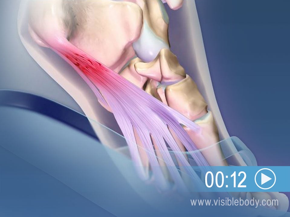足底筋膜炎が反復性の足の緊張から起こる可能性