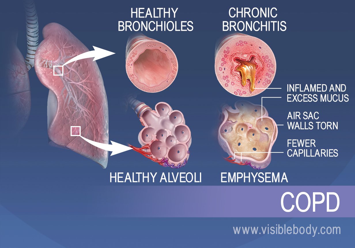 How Does Heart Disease Affect The Respiratory System Captions Viral Today