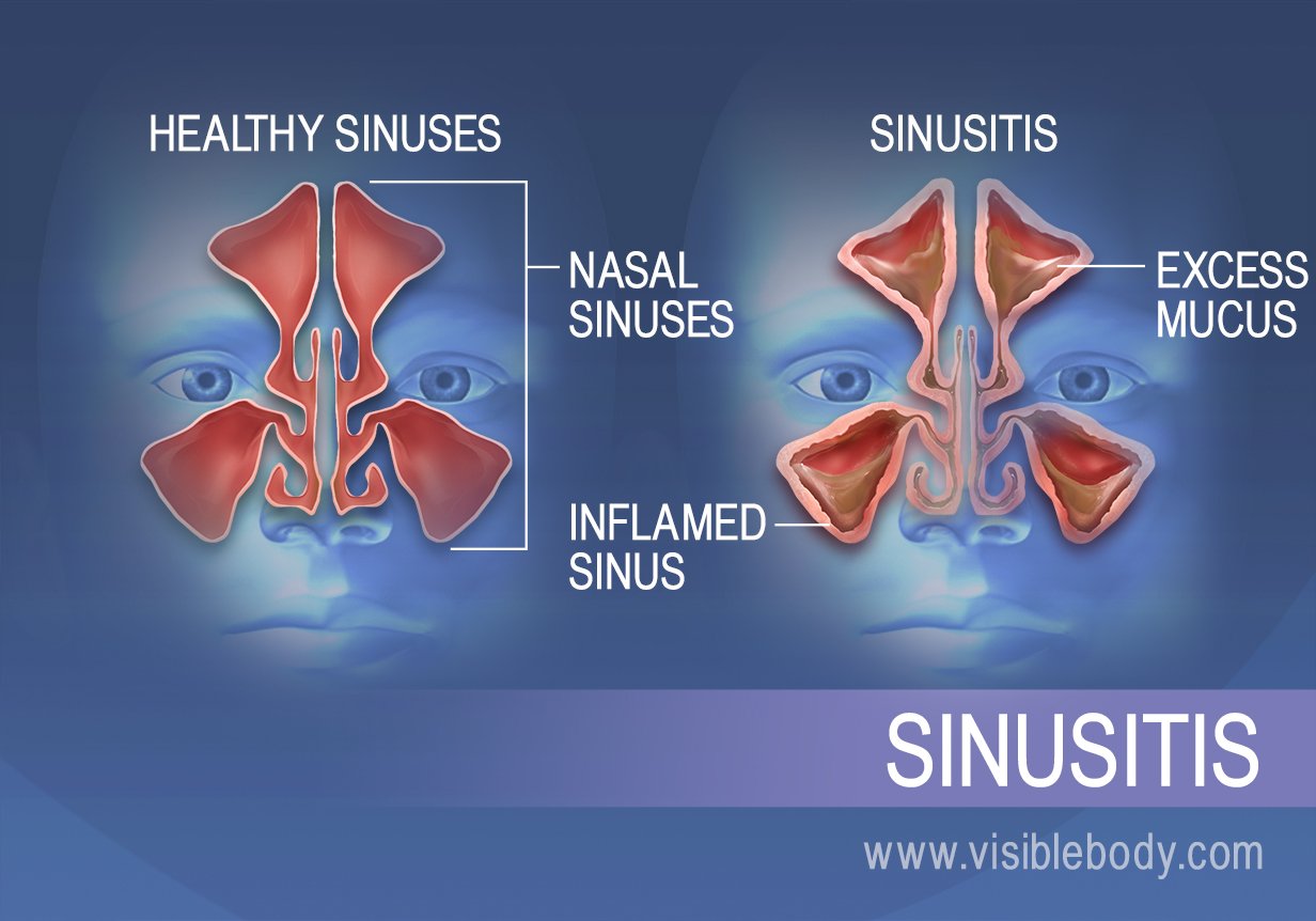 Dutiny osob trpících sinusitidou mají nadbytek hlenu a zanícené stěny dutin
