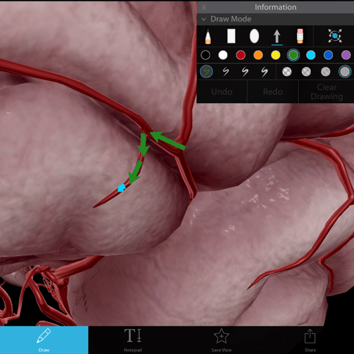 annotation clot