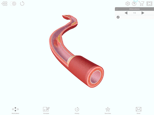 Atherosclerosis-PP-gif