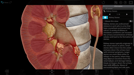 kidney-stones-model