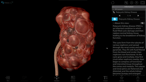 polycystic-kidney-disease-model