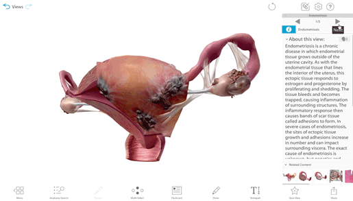 endometriosis-3d-lesson-1