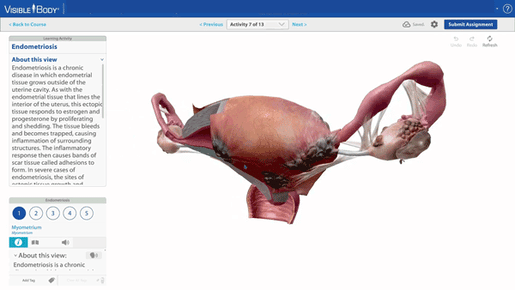 endometriosis-model-in-IA