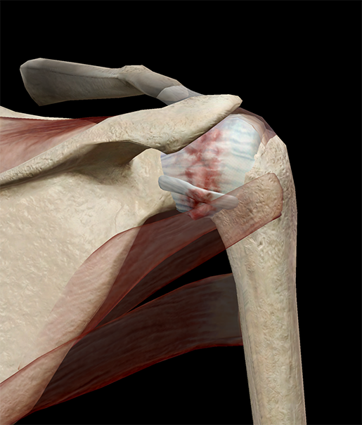 Brrrr! A Chilling Look at Adhesive Capsulitis (Frozen Shoulder)