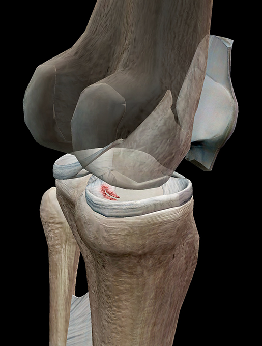 medial meniscus tear