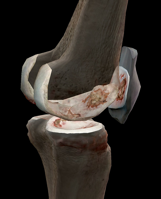 osteoarthritis-degenerated-articular-cartilage-knee