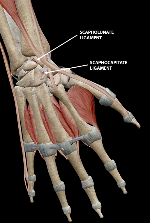 sprains-wrist-scapholunate-scaphocapitate-ligaments