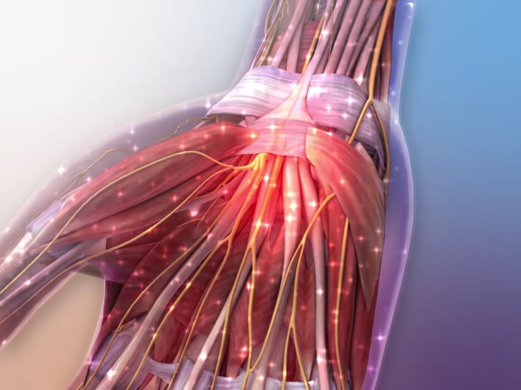 Animation still of Carpal Tunnel Syndrome