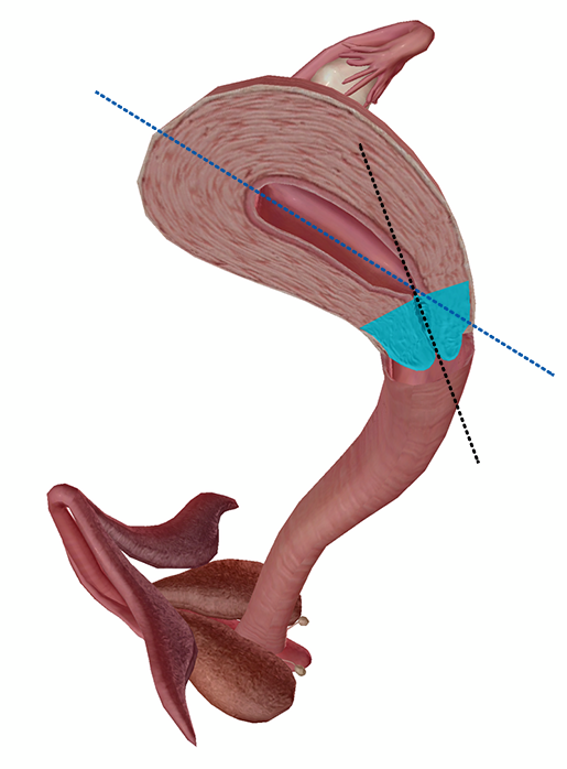 uterus-cervix-long-axis-comparison