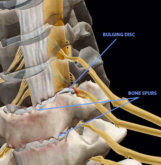 spinal-pathologies-cervical-spondylosis-update