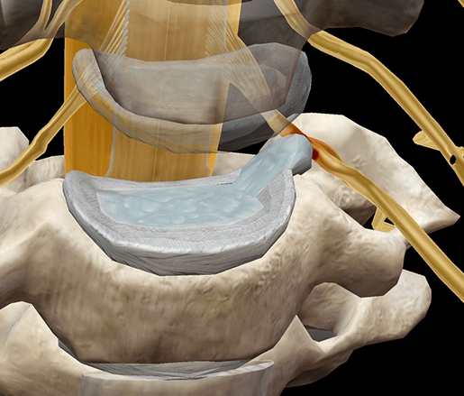 Rare Spinal Disc When Your Spine Feels Less Than Fine: Common Spinal Pathologies