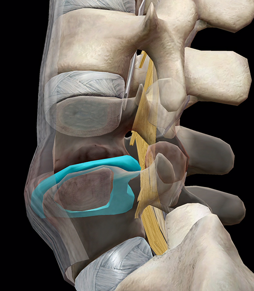 spinal-pathologies-lumbar-spinal-stenosis-update