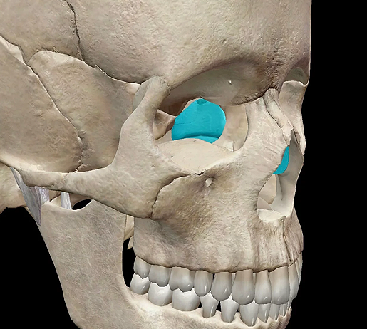 Sinusitis Etmoid Sinusitis Etmoid