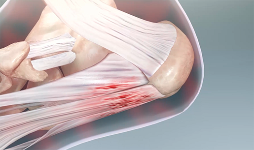 fascia-plantar-fascia-microtears