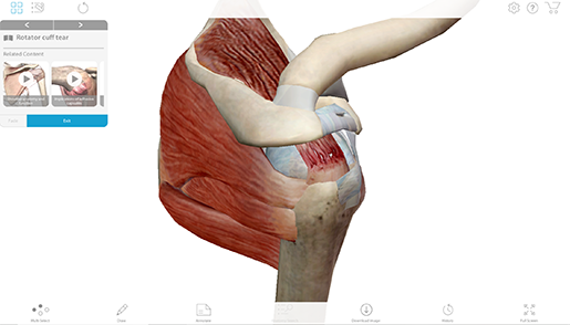 rotator-cuff-tear-full-view