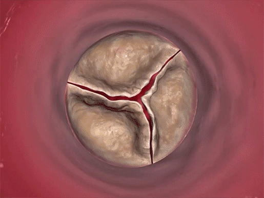 aortic-valve-stenosis-gif