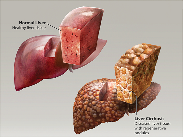 liver-cirrhosis-hepatitis-blog