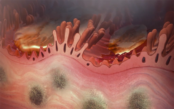 small-intestine-lining-crohns