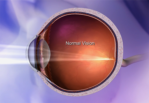 retina-focusing-light-nornal-vision