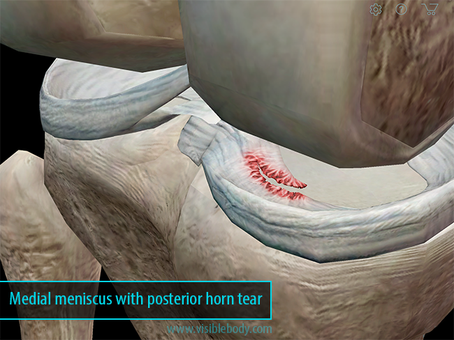 icd 10 medial meniscus tear posterior horn