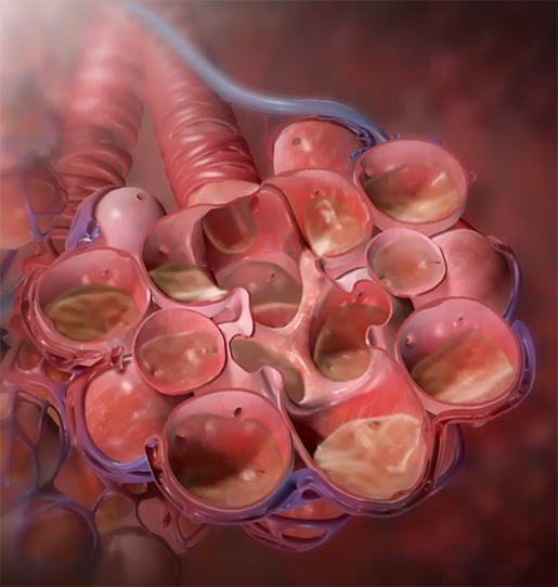 pneumonia-flu-complication