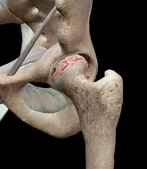 hip-osteoarthritis-degenerated-cartilage-femur-acetabulum
