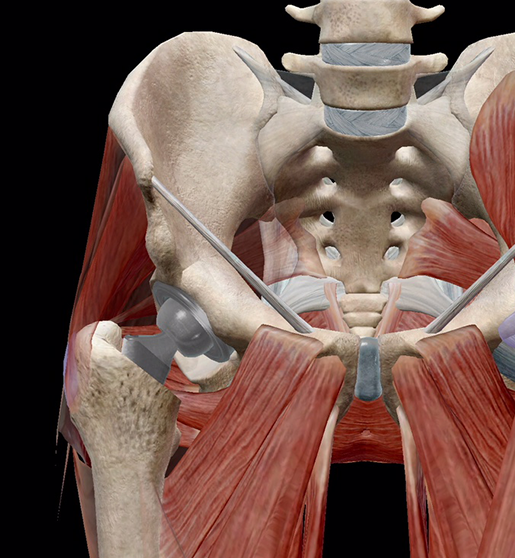 hip-osteoarthritis-hip-replacement