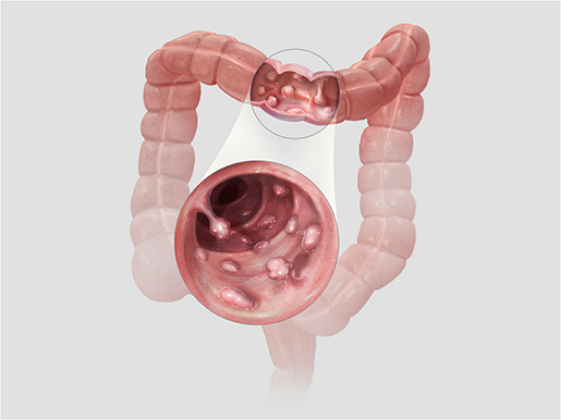 gastrointestinal-pathologies-colorectal-cancer-polyps