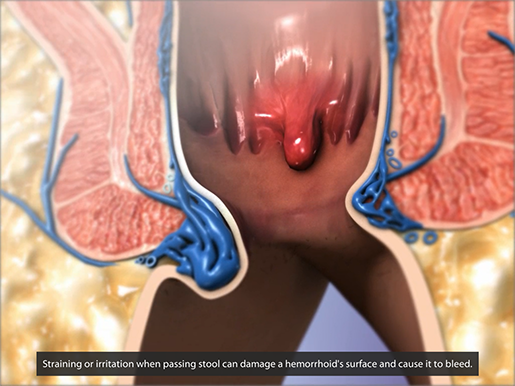 gastrointestinal-pathologies-hemorrhoids