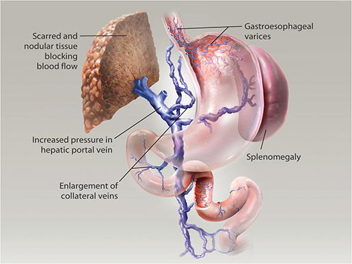 gastrointestinal-pathologies-portal-hypertension-liver-cirrhosis