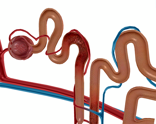 kidney-pathologies-acute-tubular-necrosis