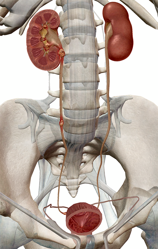 kidney-pathologies-kidney-stones