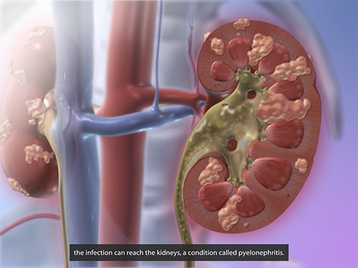 kidney-pathologies-urinary-tract-infection