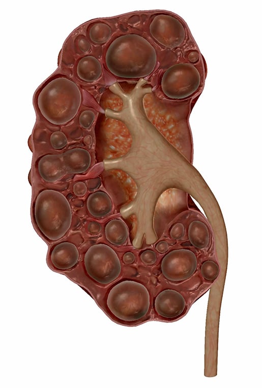 kidney-with-polycystic-kidney-disease