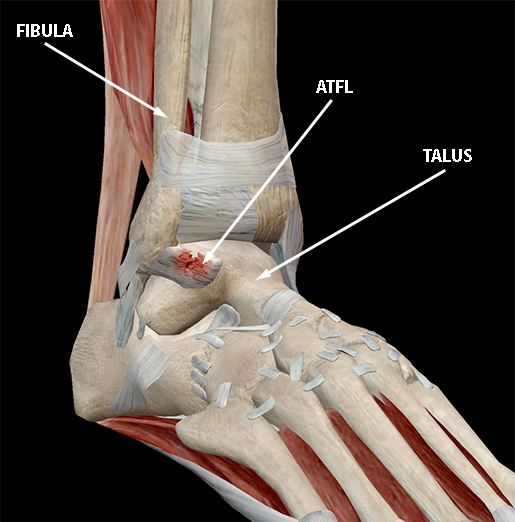 musculoskeletal-pathologies-ankle-sprain