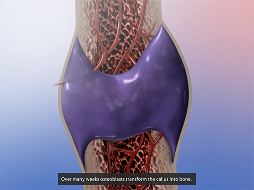 musculoskeletal-pathologies-bone-callus-osteoblasts