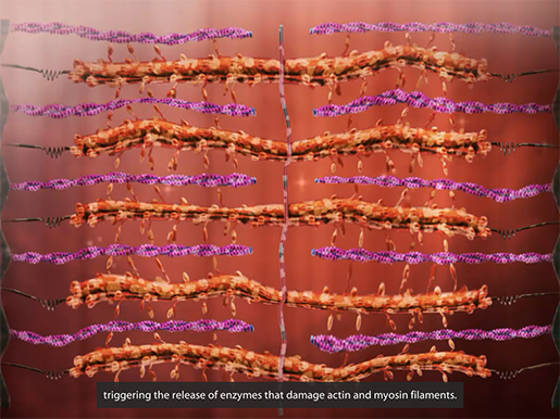 musculoskeletal-pathologies-duchenne-muscular-dystrophy-filaments