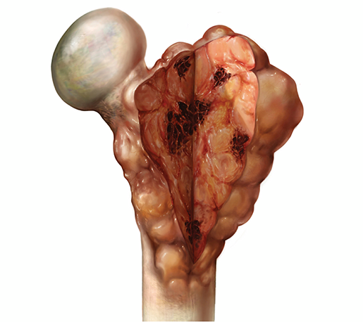 musculoskeletal-pathologies-osteosarcoma