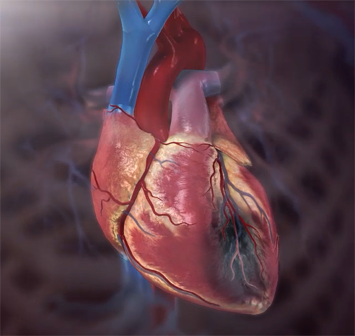 myocardial-infarction-heart-attack-physiology-pathology