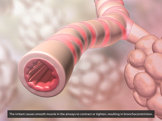 respiratory-pathologies-asthma-bronchoconstriction