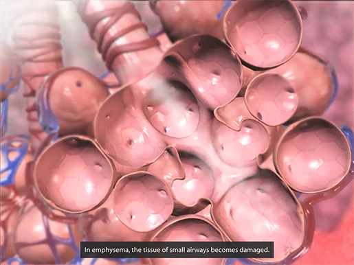 respiratory-pathologies-emphysema