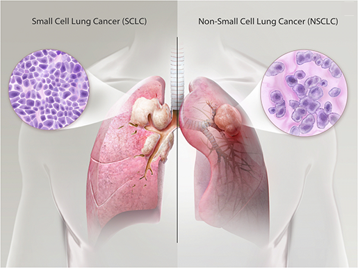 respiratory-pathologies-lung-cancer